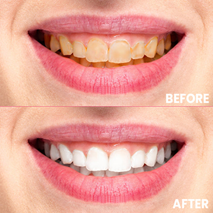 LIMETOW™ Teeth Whitening Strips